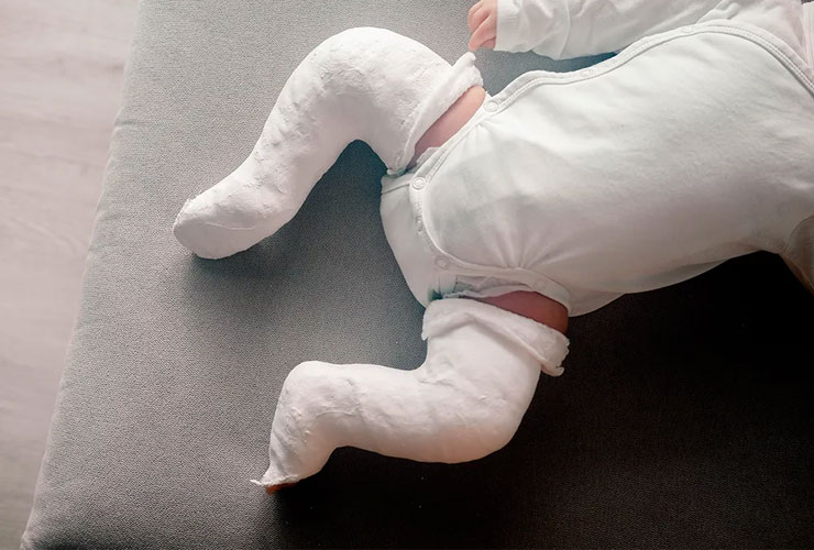 Clubfoot Treatment in Anand: Early Treatment Can Transform Your Child’s Future