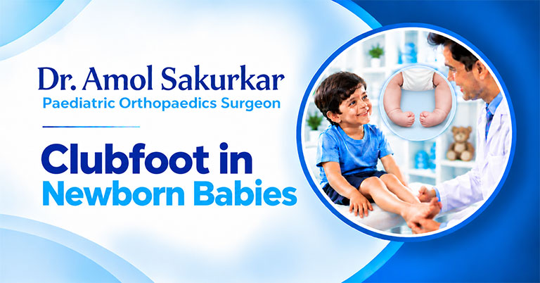 Clubfoot in Babies: Early Signs and Treatment